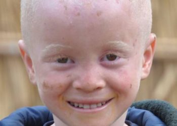 Pessoas com albinismo sofrem ataques e abusos em todo o mundo, principalmente na África - Foto: Unicef/ Moçambique Sergio Fernandez