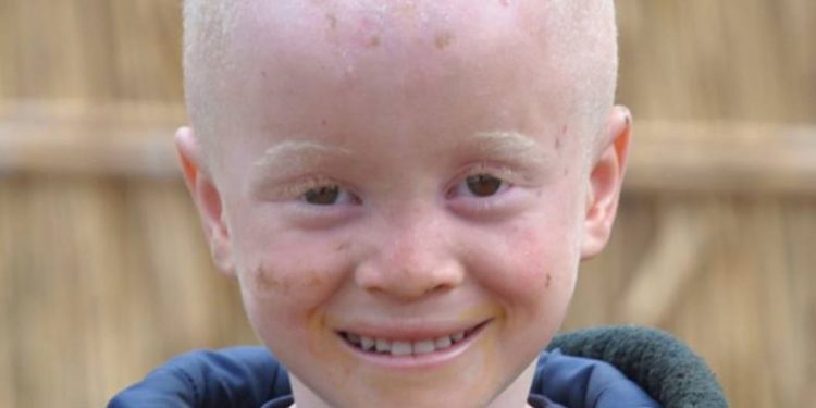 Pessoas com albinismo sofrem ataques e abusos em todo o mundo, principalmente na África - Foto: Unicef/ Moçambique Sergio Fernandez
