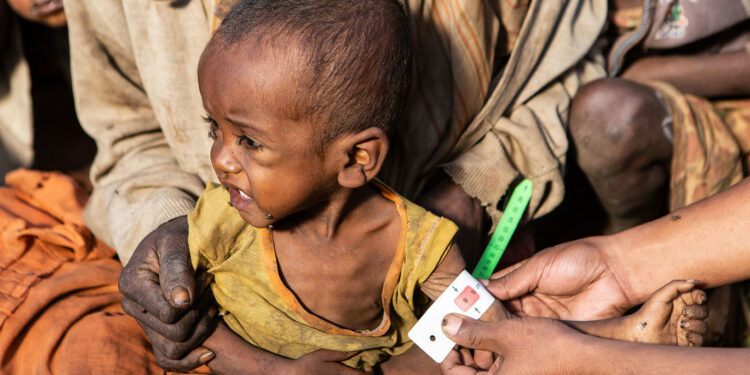 Crianças menores de cinco anos estão entre as mais afetadas pela desnutrição no Madagascar Foto: WFP/Tsiory Andriantsoarana