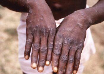 Mais de 100 casos da infecção viral foram relatados em países da África. Foto: CDC
