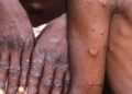 casos de infecção pelo vírus monkeypox foram verificados nos Estados Unidos. Foto: Reprodução