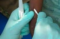 Valinhos investiga primeiro caso suspeito de varíola dos macacos