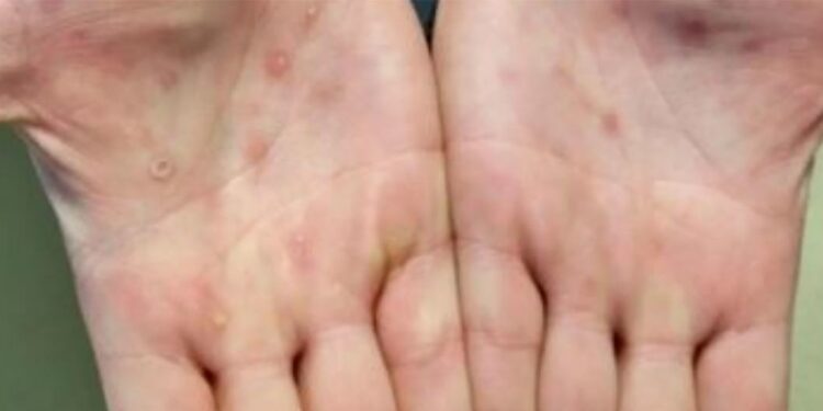 As lesões da varíola geralmente aparecem nas palmas das mãos. Foto: ONU/Divulgação