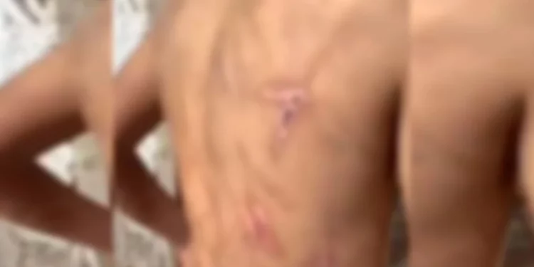 Garoto exibe marcas da tortura apçicada pelos pais. Foto: Reprodução