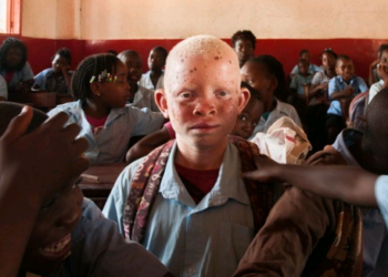 Dia Internacional sobre Conscientização para o Albinismo: todo 13 de junho - Foto: Unicef