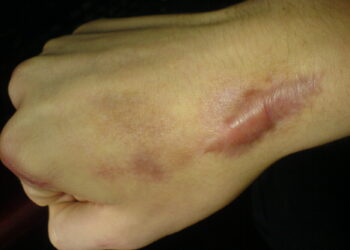 Queloides sao cicatrizes que se formam devido ao excesso de colágeno durante o processo de cicatrização. Fotos: Divulgação