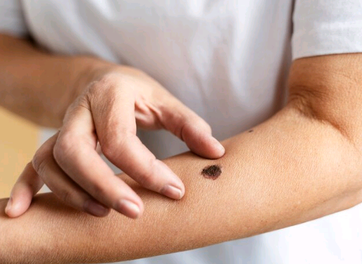 Artigo – Melanoma: avanços e atenção constante! – por Vinícius Corrêa da Conceição 