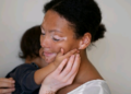 Dia Mundial do Vitiligo: doença é caracterizada pela despigmentação da pele - Foto: Freepik