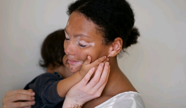 Vitiligo: doença pode ser controlada com tratamento adequado
