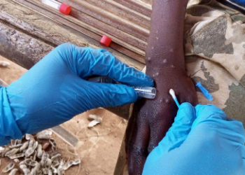 Caso de Varíola M na Suécia reforça apelo por vigilância e vacinação, alerta OMS