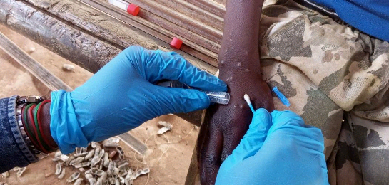 Caso de Varíola M na Suécia reforça apelo por vigilância e vacinação, alerta OMS