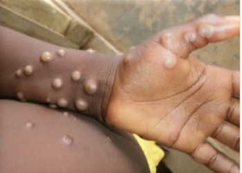 Agência da ONU faz apelo por US$ 18,5 bi para combater mpox