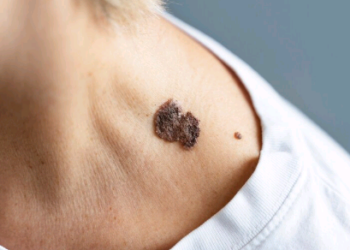 Confira 9 mitos e verdades sobre câncer de pele