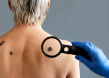 ‘Dezembro Laranja’: você sabe identificar pintas ‘suspeitas’ para o câncer de pele?