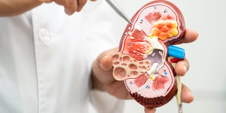 Verão aumenta riscos de pedras nos rins e infecções urinárias; veja como evitar