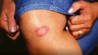 Hanseníase: conheça verdades e mitos sobre a doença