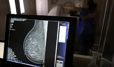 AGU processa médico que apontou mamografia como causadora de câncer