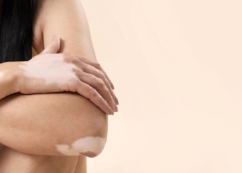 Vitiligo: um caso de sucesso – por Márcia Romão