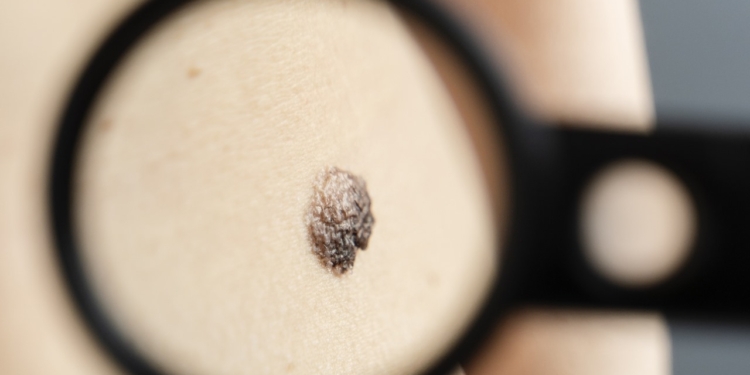 Centro de Oncologia Campinas realiza ação gratuita para detecção de câncer de pele