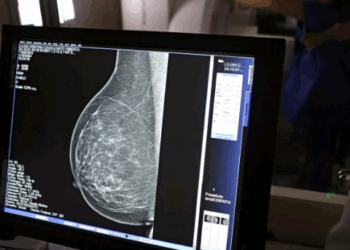 Baixa adesão à mamografia dificulta diagnóstico de câncer de mama