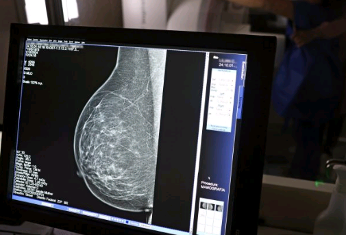 Baixa adesão à mamografia dificulta diagnóstico de câncer de mama