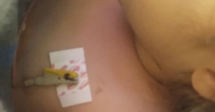 Criança é picada por escorpião e falta de soro em Jaguariúna repete cenário de desespero