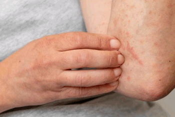 1º de outubro é ‘Dia Mundial da Urticária’: entenda a doença e saiba como prevenir crises