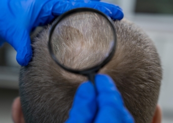 Transplante capilar: 5 perguntas para entender o procedimento