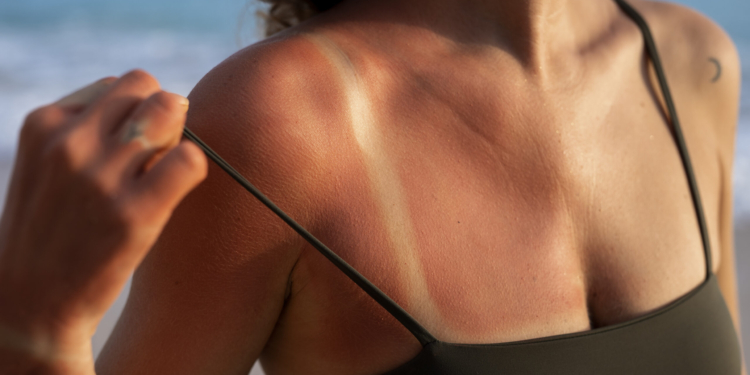 Bronzeamento em câmaras UV aumenta em 75% os riscos de câncer de pele