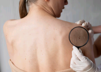 Câncer de pele e desinformação: por que buscar orientações seguras é essencial na prevenção