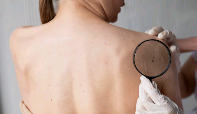 Câncer de pele e desinformação: por que buscar orientações seguras é essencial na prevenção