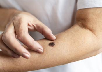 Mutirão na Unicamp realiza exames para detecção do câncer de pele