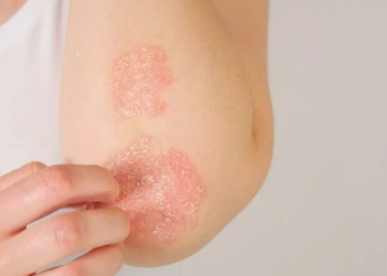Psoríase exige atenção aos sinais do corpo e tratamento adequado