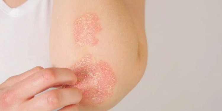 Psoríase exige atenção aos sinais do corpo e tratamento adequado