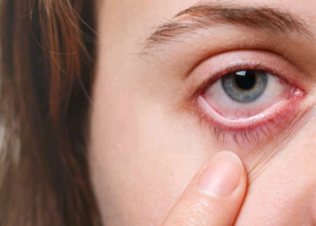 Conjuntivite: a mais frequente doença ocular externa durante o Verão