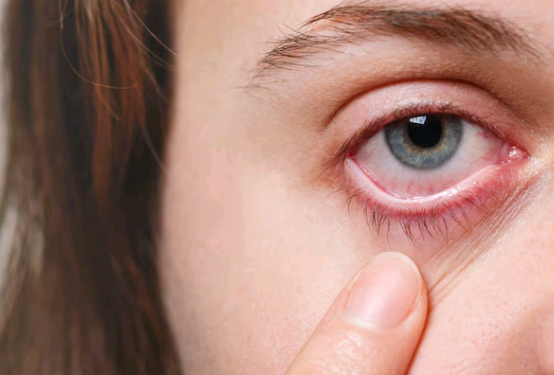 Conjuntivite: a mais frequente doença ocular externa durante o Verão