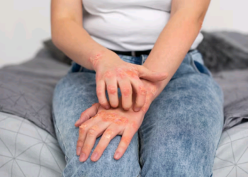 Janeiro Roxo: atenção aos primeiros sinais e a importância do diagnóstico precoce da hanseníase