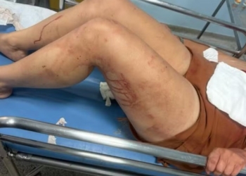 Mulher sofre lesões graves na cabeça ao ser atingida por companheiro em Sumaré