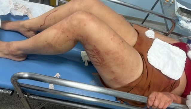 Mulher sofre lesões graves na cabeça ao ser atingida por companheiro em Sumaré