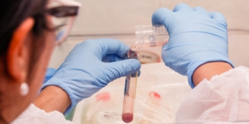 Exame de sangue associado à IA abre caminho para diagnóstico precoce da hanseníase