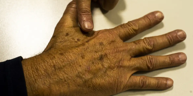 Desinformação sobre câncer de pele afeta diagnóstico, diz instituição