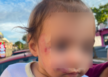 Prefeitura descredencia creche após bebê voltar para casa com ferimentos no rosto em Sumaré